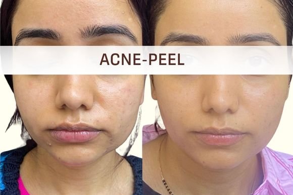 Acne Peel
