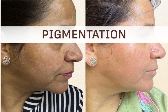 Pigmentation